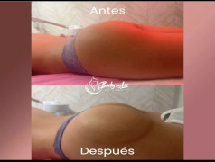 Butt Lift